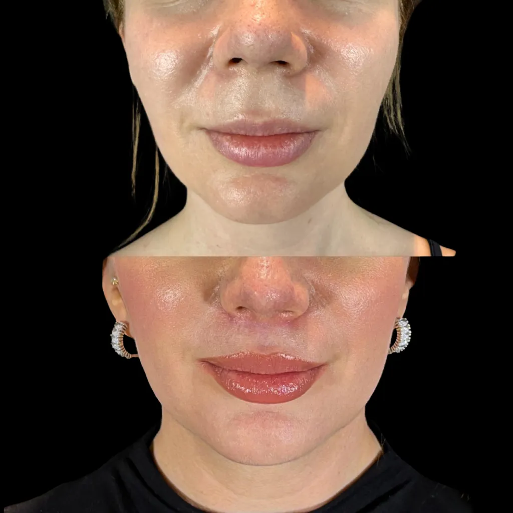 LipLift, öncesi ve sonrası