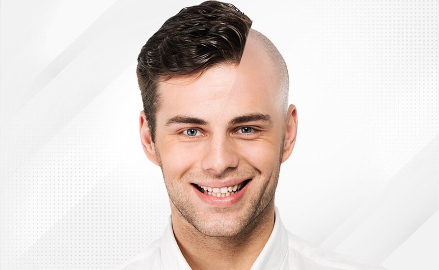 Hair Transplantation