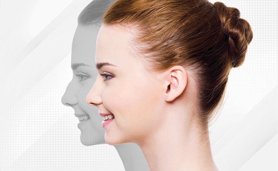 Rhinoplastik